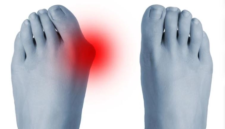 ইউরিক অ্যাসিড বাড়লে কী করবেন