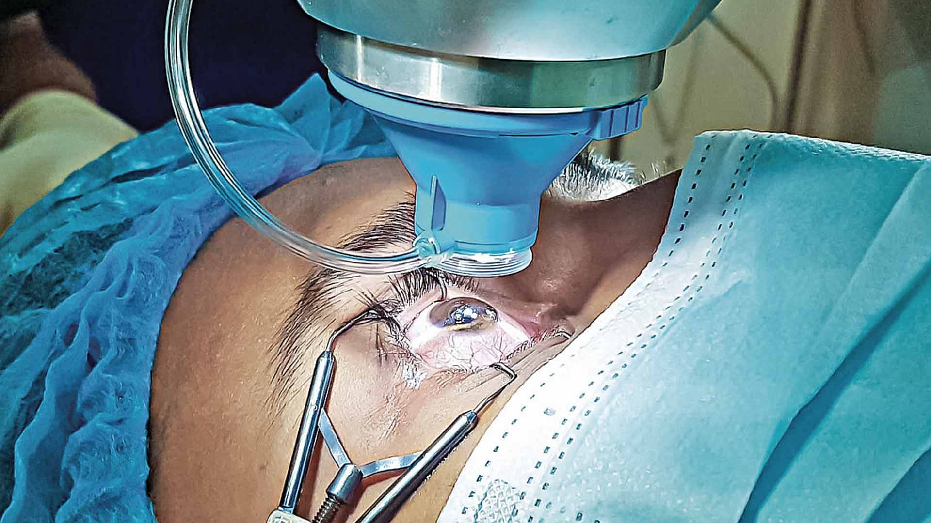 চোখের কৃত্রিম লেন্স: সর্বনিন্ম ১৪৩ টাকা, সর্বোচ্চ ১ লাখ ২৬ হাজার