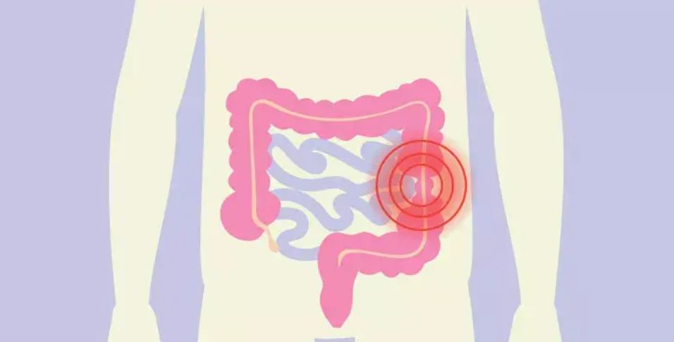 আইবিএস কী ও কেন হয়, কোন লক্ষণে বুঝবেন
