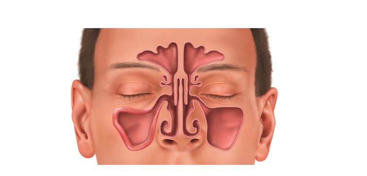 সাইনুসাইটিসের কারণ ও ধরন, প্রতিরোধে যা করবেন