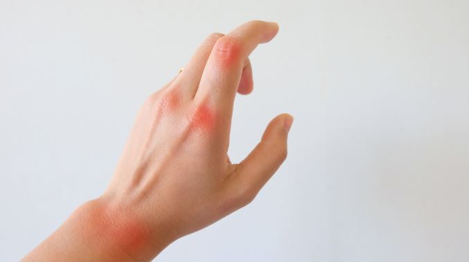 রিউমাটয়েড আর্থ্রাইটিস কেন হয়, লক্ষণ ও চিকিৎসা কী