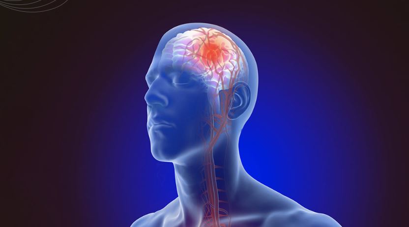 স্ট্রোকের লক্ষণ ও কারণ, প্রতিরোধে যা করবেন