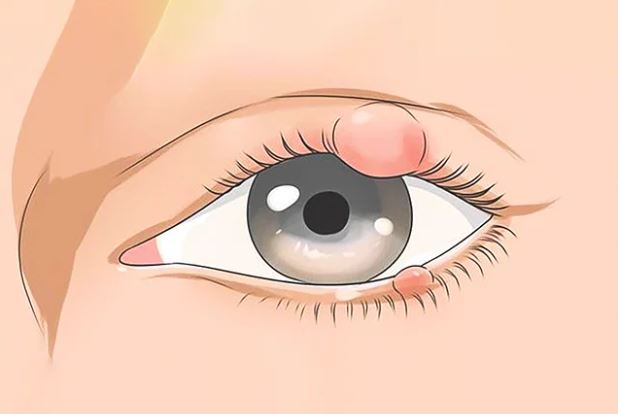 চোখে অঞ্জনি হলে কী করবেন
