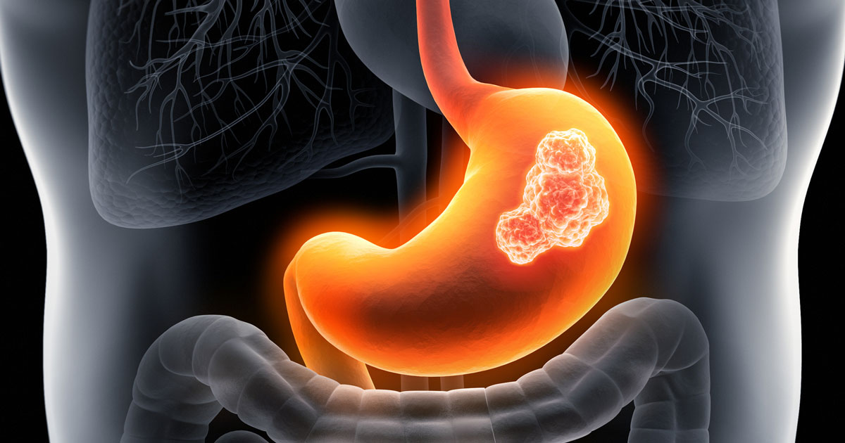 পাকস্থলীর ক্যানসার কেন হয়, লক্ষণ ও প্রতিরোধ