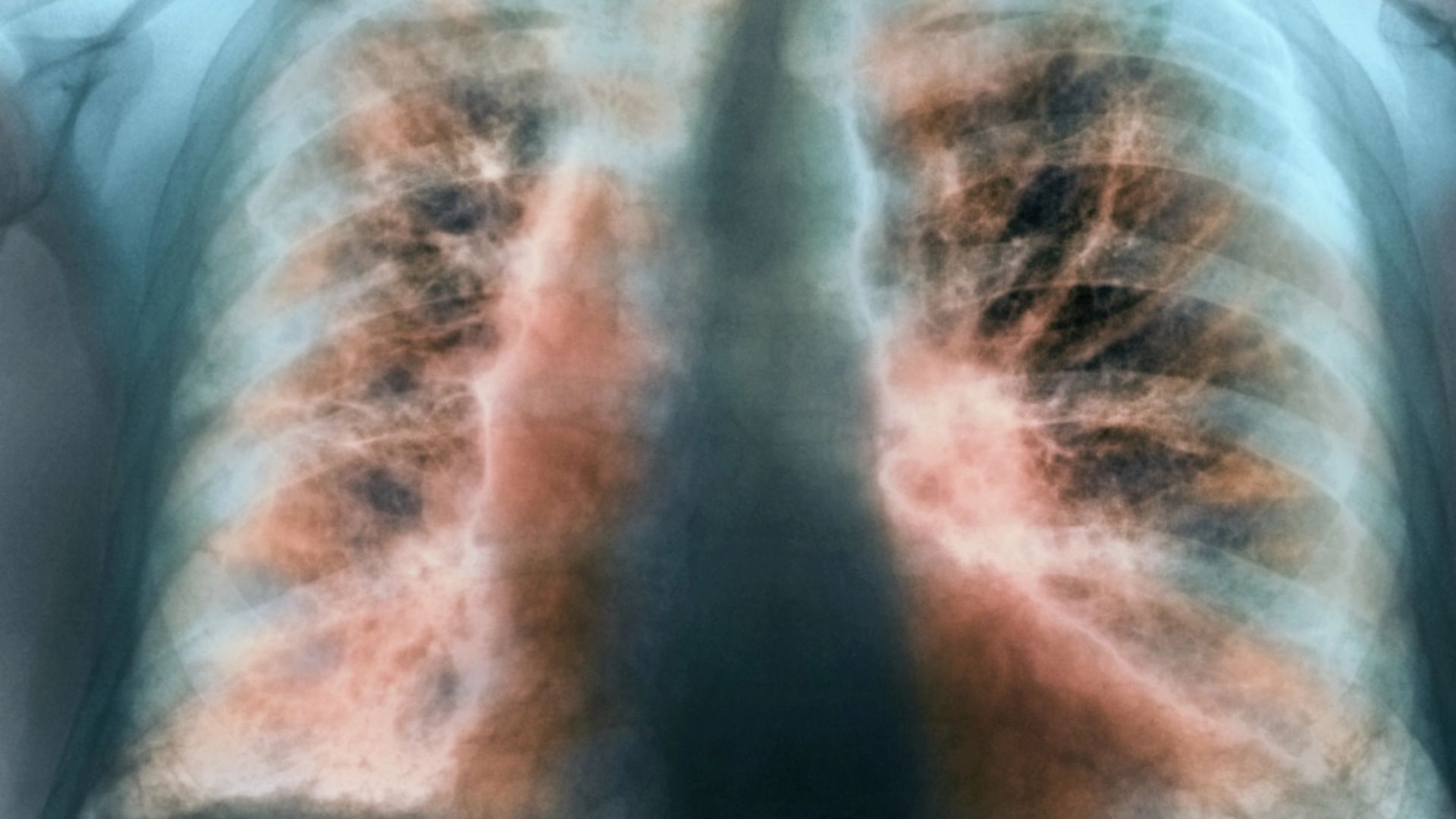 কোন রোগে ভুগছিলেন ওস্তাদ জাকির হোসেন, কেন হয়, কাদের হয়