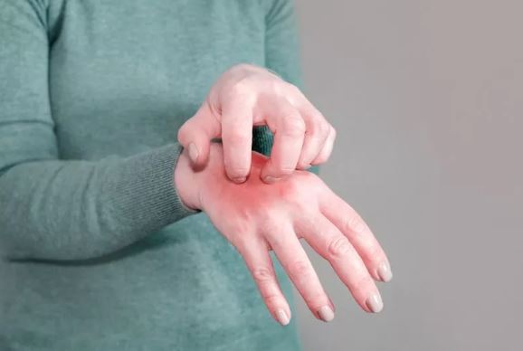 স্ক্যাবিস বা খোসপাঁচড়া হলে কী করবেন, প্রতিরোধে করণীয়