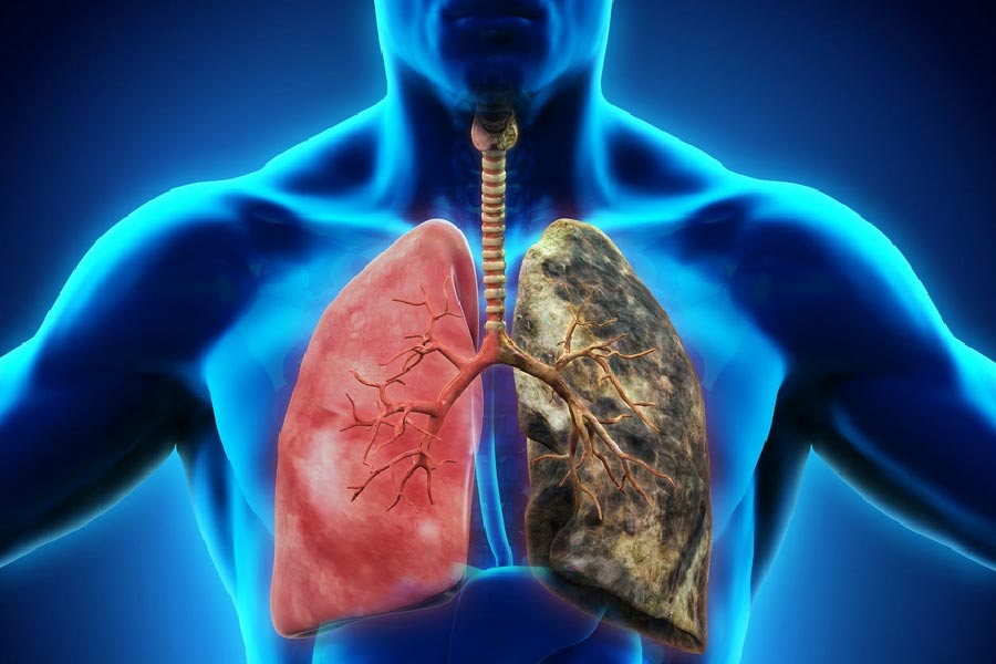 ফুসফুসের ক্যানসারের কারণ ও লক্ষণ, প্রতিরোধে যা করবেন