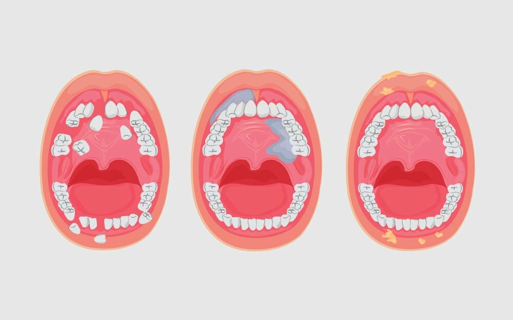 মুখ ও মুখগহ্বরের ক্যানসার কেন হয়, লক্ষণ ও শনাক্ত করার উপায়