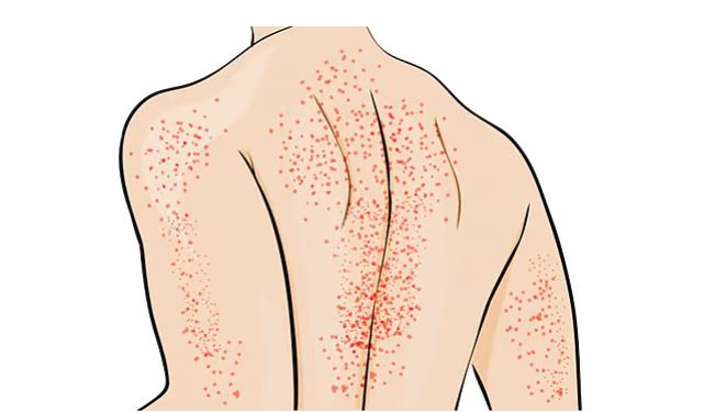 রক্তরোগ ইমিউন থ্রম্বোসাইটোপেনিয়া বা আইটিপি নিয়ে যা জানা প্রয়োজন