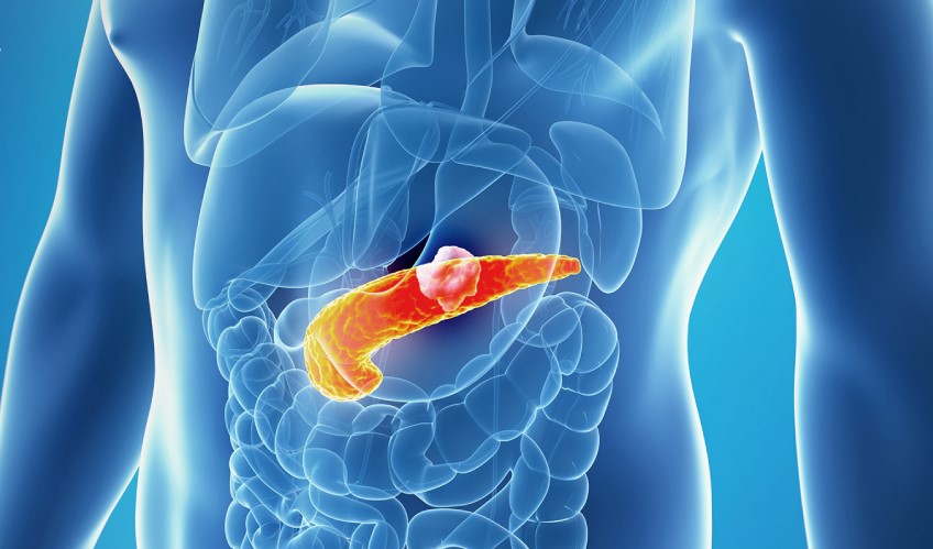 অগ্ন্যাশয়ের ক্যানসার কেন হয়, লক্ষণ ও চিকিৎসা কী