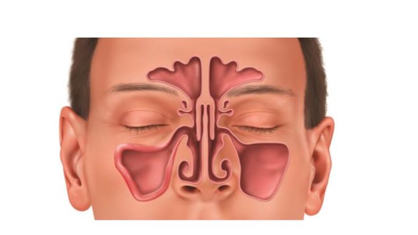 সাইনোসাইটিস