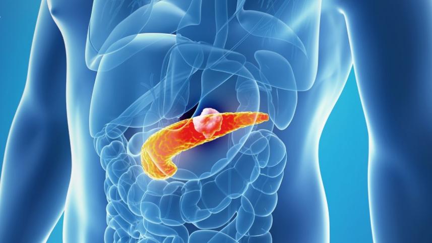 অগ্ন্যাশয়ের ক্যানসার 