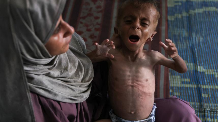 Gaza Malnourished Child